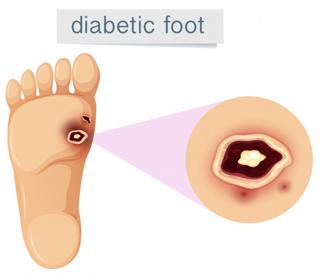 diabetic-foot-white-background_1308-15325